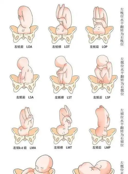 这种胎位最适合顺产;臀位:是指臀先露,胎儿的屁股朝下头朝上;横位:是