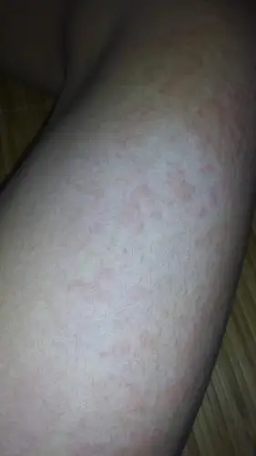 我全身都红红的,脸也有,请问高人这是皮肤过敏吗?