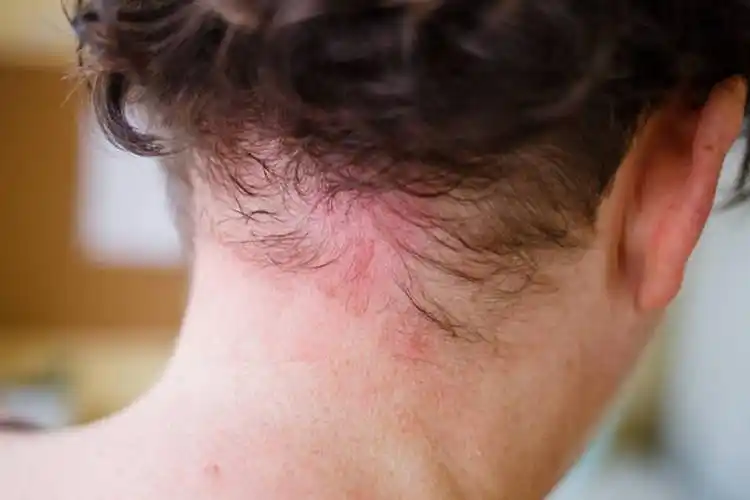 脖子过敏皮肤红斑图