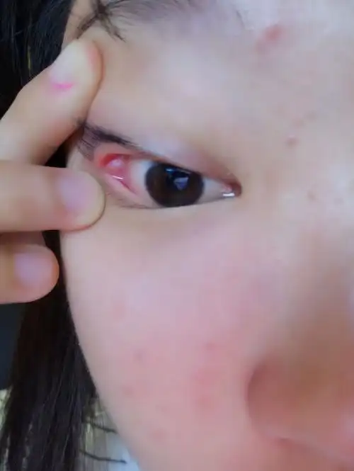 左眼靠外的眼角里面涨了个白色疙瘩前几天一直以为结膜炎请问下这