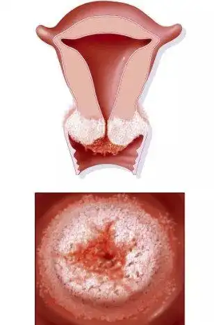 白带带血,性接触后少量阴道流血或妇科检查后阴道出血,宫颈糜烂等