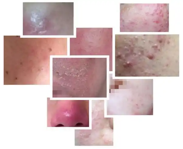 激素性皮炎研究院发表的所有文章 | 激素依赖性皮炎研究院官方网站