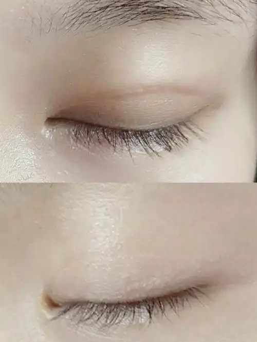 做的全切双眼皮闭眼无痕超自然