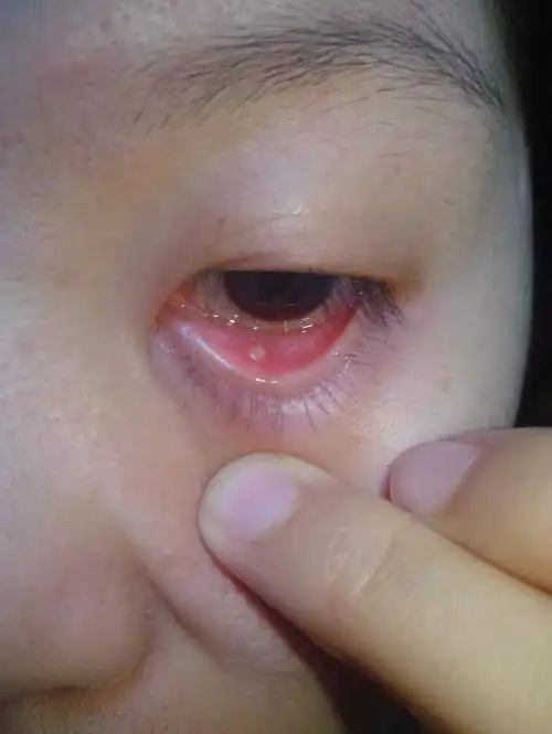 眼袋里长了这个,不痛不痒的 谁知道这个是这个是啥?