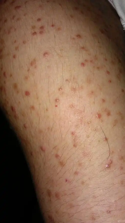 麻疹? - 皮肤及性传播疾病讨论版 - 爱爱医医学论坛