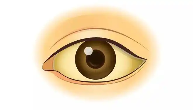 这时,皮肤,眼睛巩膜(俗称"眼白")会出现黄染,即肉眼可见的面黄,眼黄