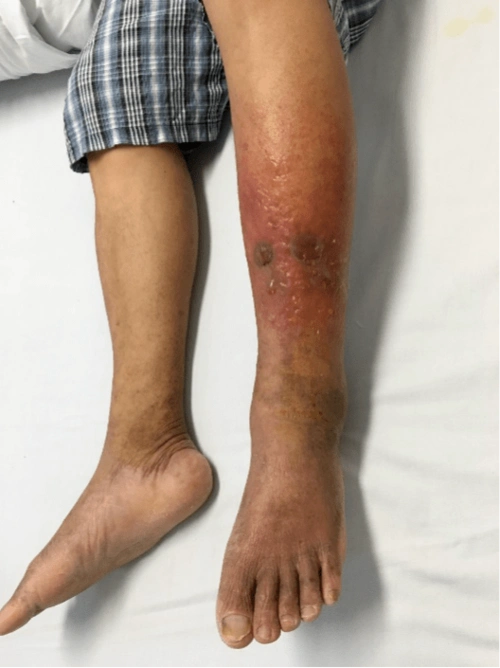 丹毒好发于腿部和面部,胸腹部,起病急,发病后,会引起局部的红斑和水泡