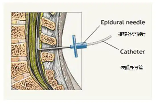 如果选择硬膜外分娩镇痛,麻醉医生将在您的下背部置入一根穿刺针和