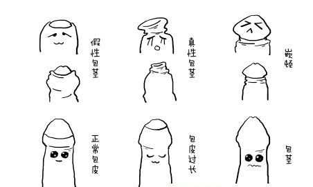 包茎嵌顿是由于包皮外口过小,包皮强行上翻或下翻,使狭小的包皮口紧箍