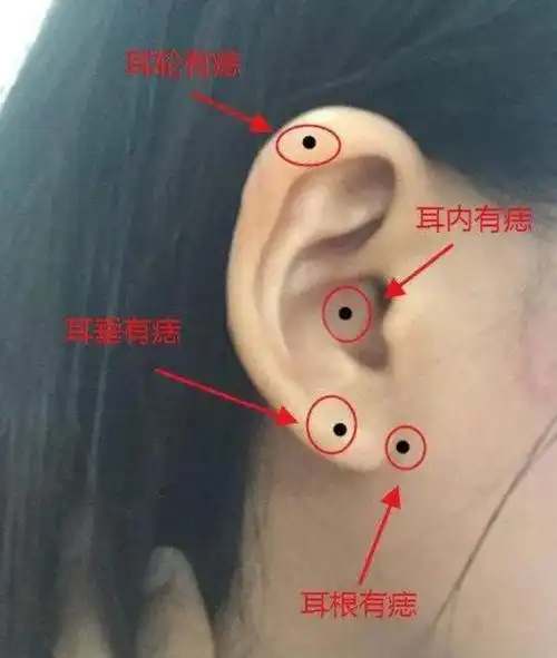 识人术:【耳朵痣篇】