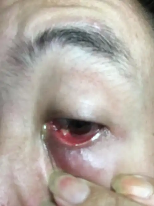 眼睑里面肿了是怎么回事