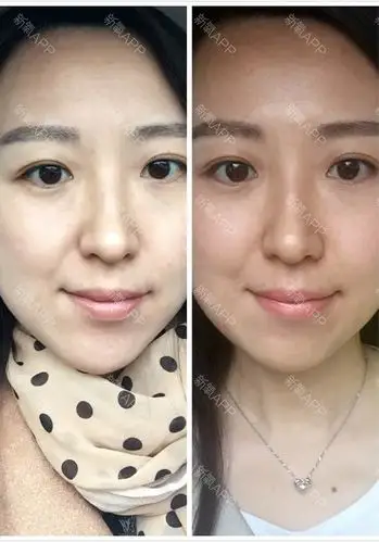 这是第六天的对比图,左图是治疗前,右图是今天,基本上毫无效果,脸好像