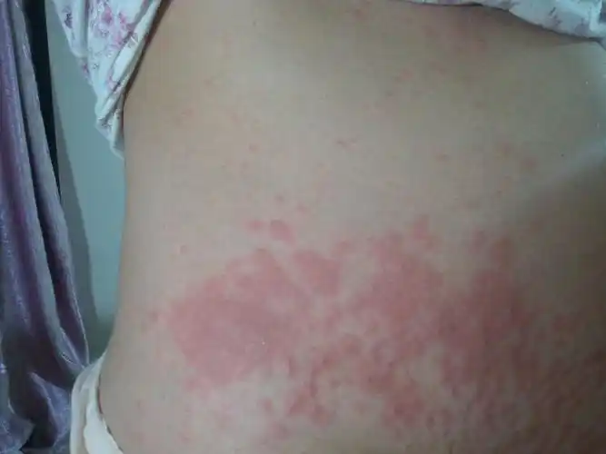 北京  病情描述(发病时间,主要症状等): 我爱人怀孕8个月了,最近身上