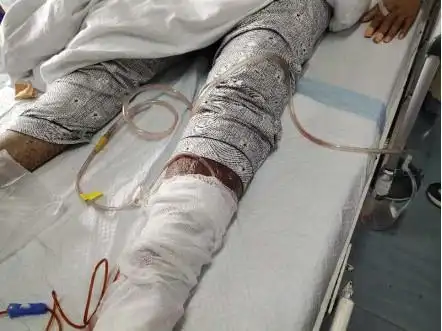 台州男子被一颗小钉子扎了下脚底差点要截肢