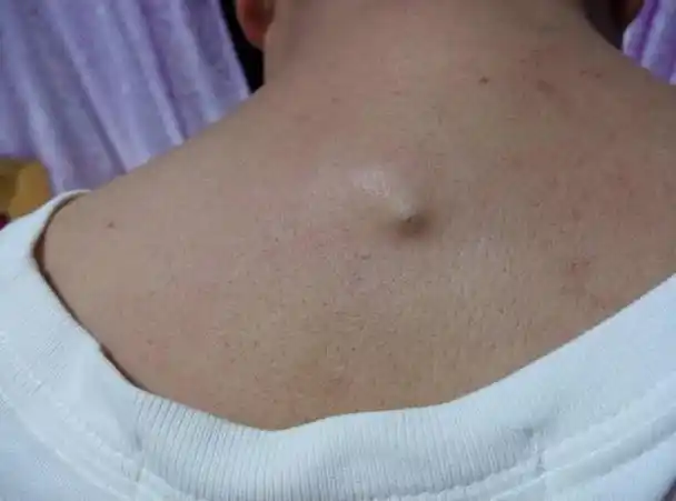 很多皮肤本来是中性的人皮肤变的爱出油,变成油性;2,后背黑头会越来越