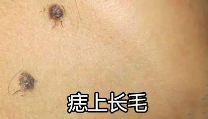 痣上长毛好不好预示着什么