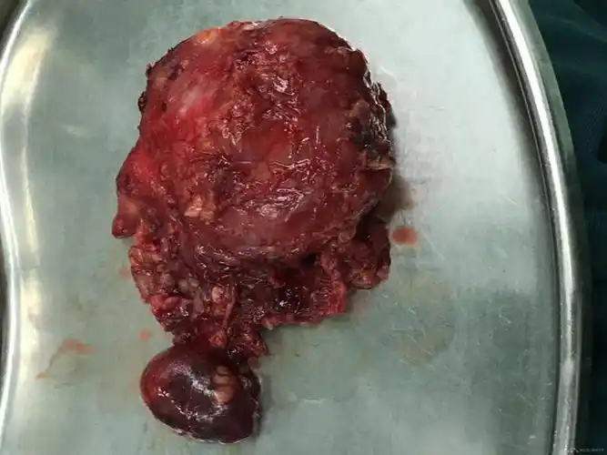 双侧腮腺腺淋巴瘤