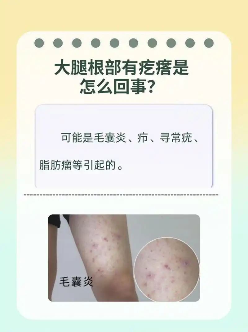 93大腿根部有疙瘩可能是毛囊炎,疖,寻常疣,皮脂腺囊肿,脂肪瘤等