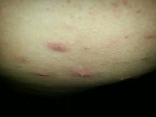 就吃了一顿烧烤,结果胸口出了七八个毒疖子,轻轻抚摸一下都疼的厉害