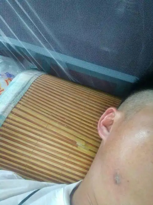 脸上肉里有硬块