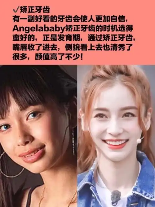1矫正牙齿 有一副好看的牙齿会使人更加自信,angelababy矫正牙齿的