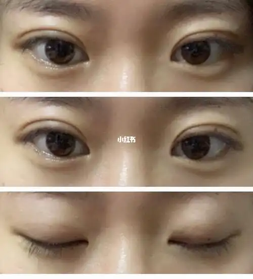 埋线双眼皮第十一天
