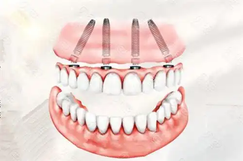 all-on-4半口种植牙示意图