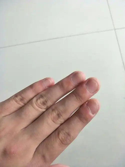 现在指甲成这样了.现在好自卑.