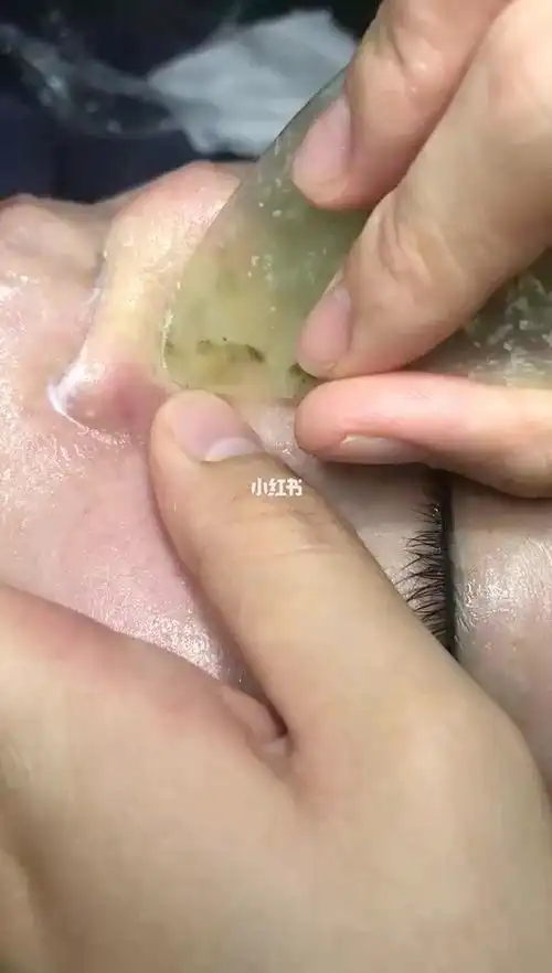 毛囊清洁术_护肤_美妆_护肤