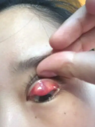 我眼皮上长了个囊肿,哺乳期,孩子八个月,除了手术别的方法能好吗?