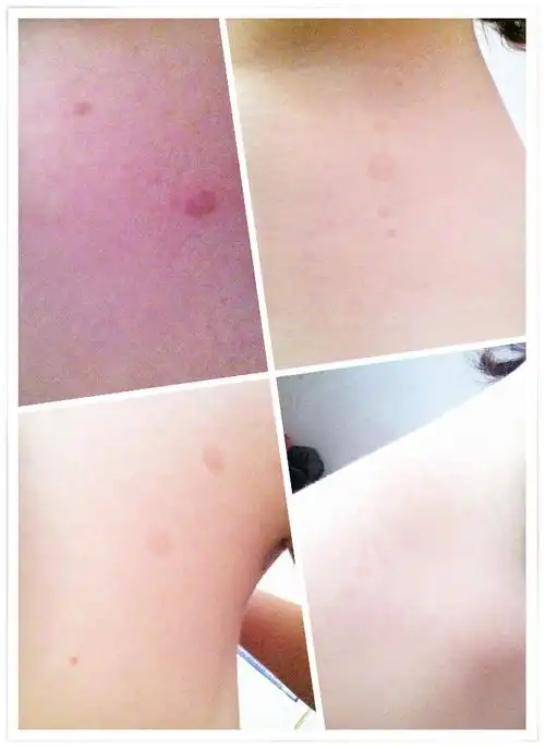 身上长类似胎记的小斑块是怎么回事?以前从没长过,不痛也不痒