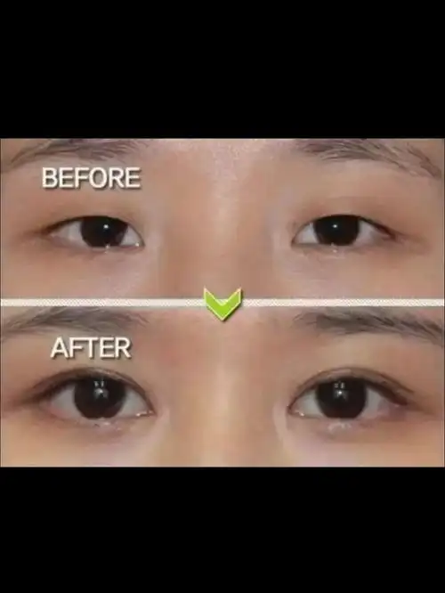 8080双眼皮和单眼皮有什么区别,从美学角度讲,双眼皮_圈子-新氧