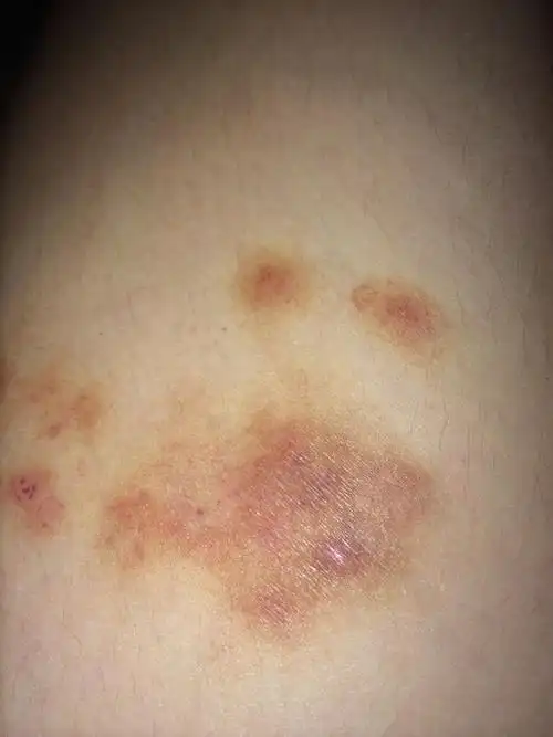 问:问:问:搽皮炎平那激素药导致皮肤萎缩,留色素给点意见怎么消得掉