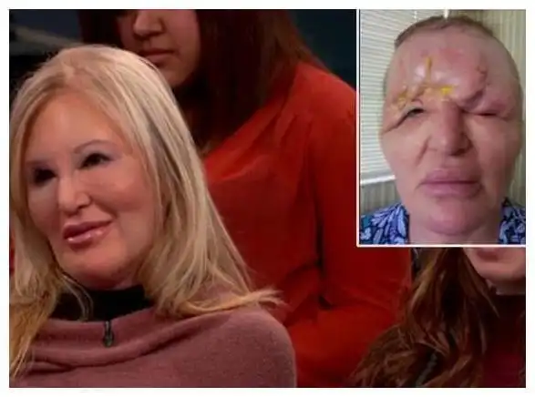 54岁女子整容失败惨遭毁容躲在室内3年不敢见人