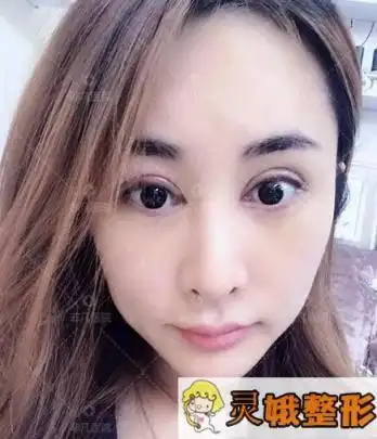 双眼皮术后恢复期