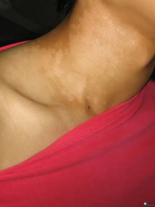 p>白斑病,是医学上对以 a target="_blank" href="/item/皮肤白斑">