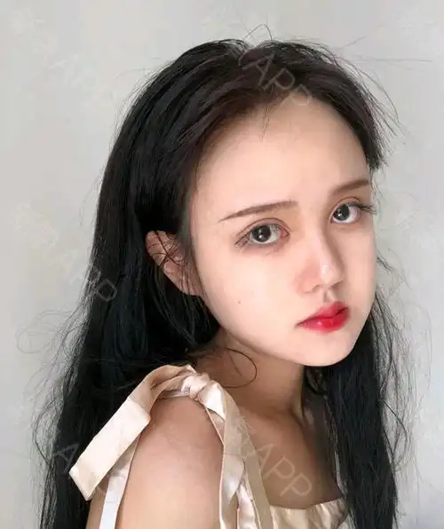 玻尿酸填充卧蚕