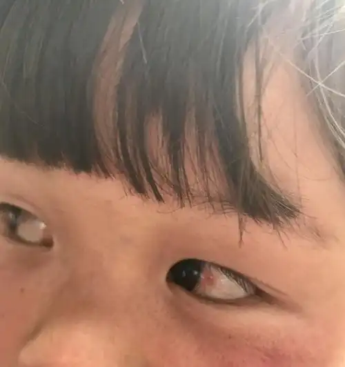 小孩眼睛里有血丝,我很担心请问下医生怎么办啊?
