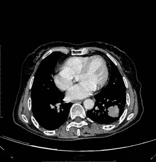 胸部ct平扫示左下肺占位肺癌
