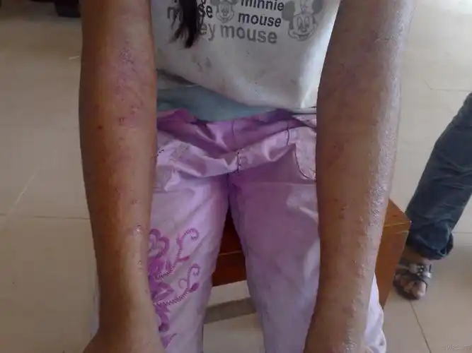 全身泛发性皮肤斑丘疹有水泡从未见过的病例