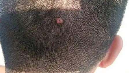 问:头上长了个肉疙瘩,有4,5年了.这是什么疙瘩呀?能切除不?