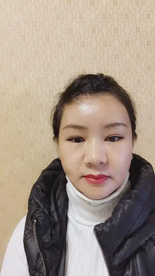 埋线提升术后10天_自体脂肪丰苹果肌术后10天_自体脂肪面部填充术后10