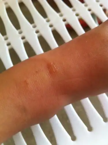 请问这是被什么咬了,小孩的脚.