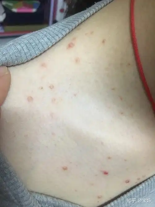 关于毛囊炎脂溢性皮炎痤疮的区别