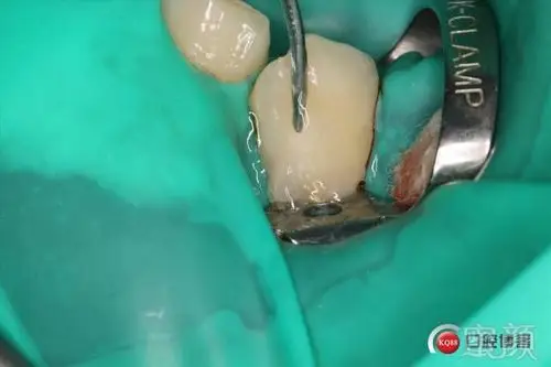 分享一组双尖牙根面龋补牙案例