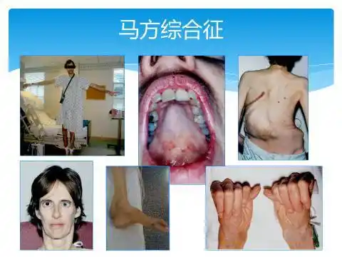 马凡综合征(marfan syndrome),为一种遗传性结缔组织疾病,为常染色体