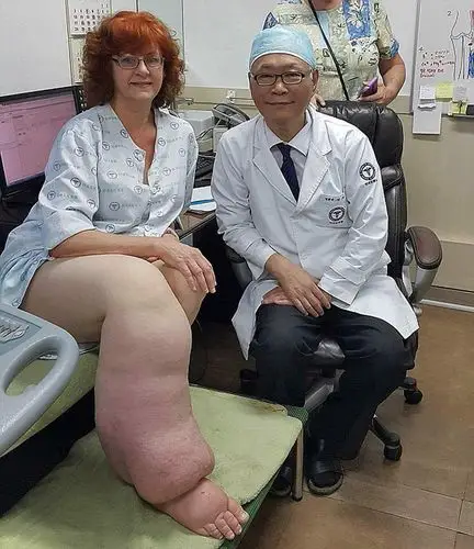 美女子患病长大象腿术后成功消肿重获新生