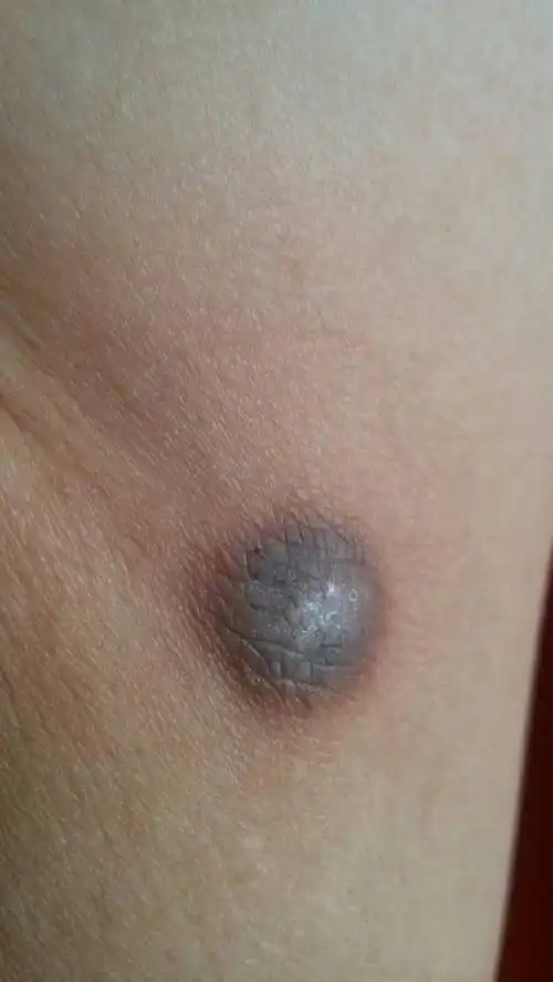 腿部 皮下长了一个硬硬的肉瘤 好几年了现在捏着感觉直径半厘米.