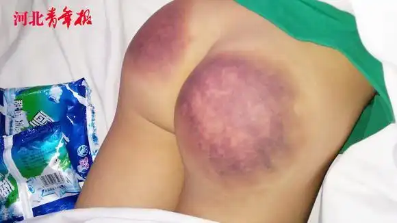 因没有背过乘法口诀 七岁男童遭老师笤帚把抽打 屁股被打"开花"-千里