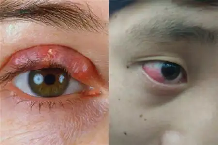 【图】眼睛发炎上火是怎么回事 和天气有关吗
